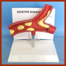 Desk Type (hypertension harmful effects) Disease Artery Model with Descritption Plate